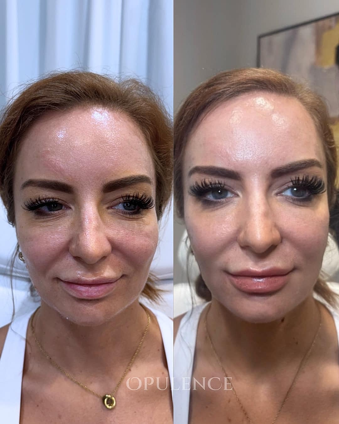 Botox, Fillers & Injectables Before & After