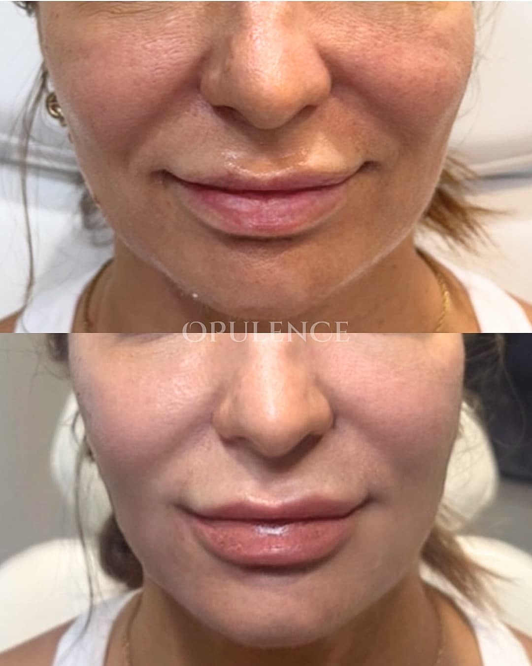 Botox, Fillers & Injectables Before & After