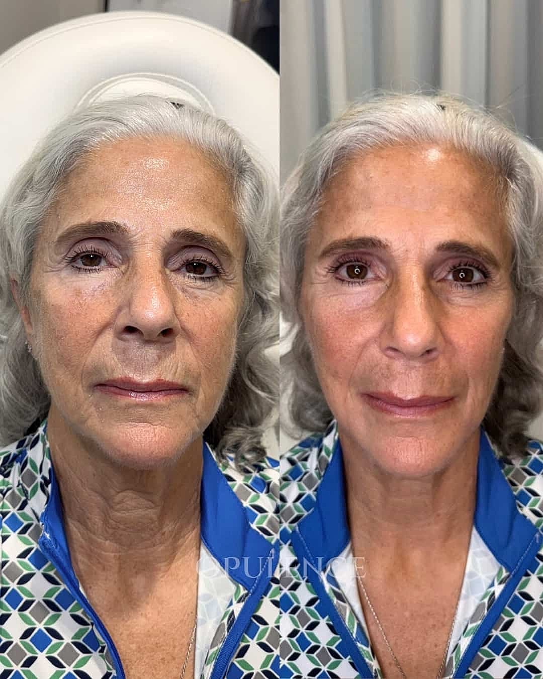 Botox, Fillers & Injectables Before & After