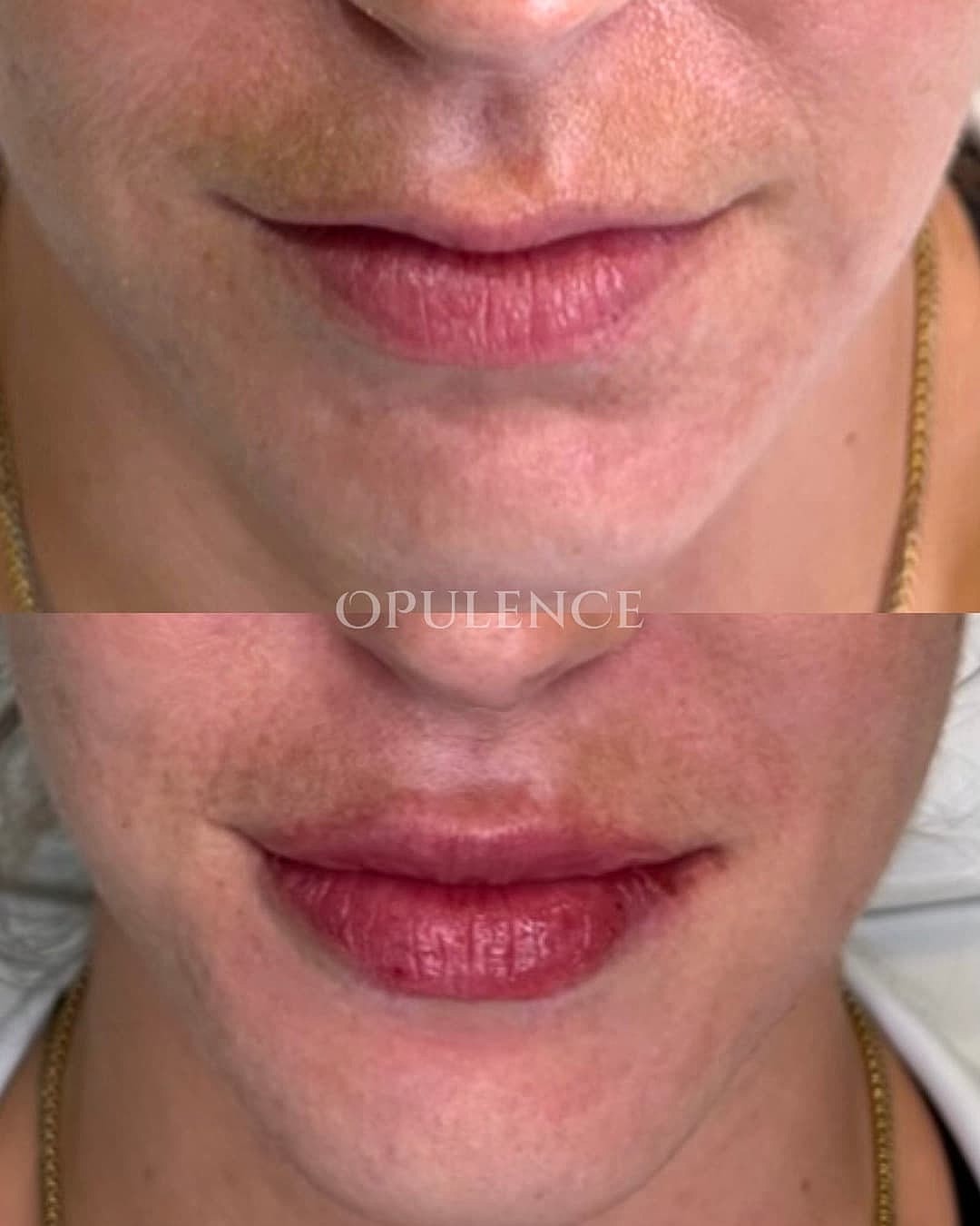 Botox, Fillers & Injectables Before & After