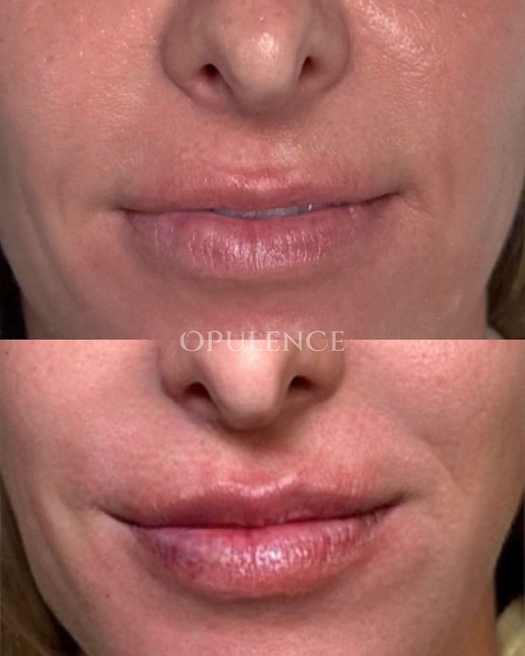 Botox, Fillers & Injectables Before & After