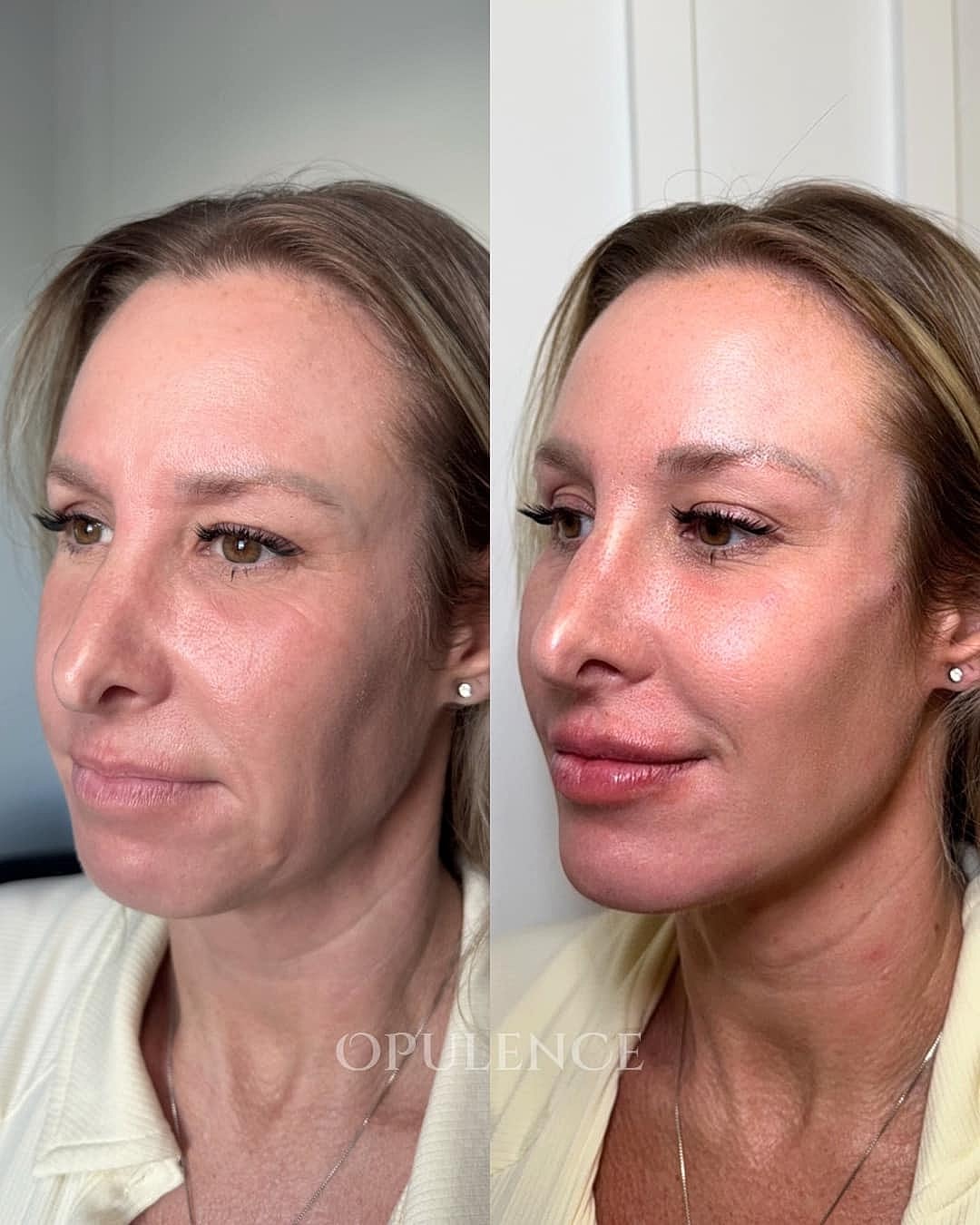 Botox, Fillers & Injectables Before & After
