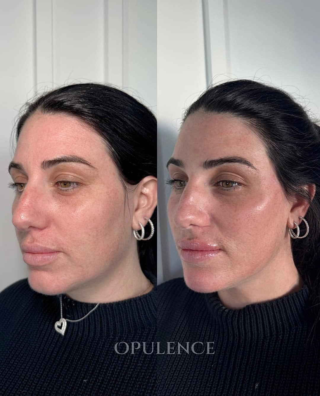 Botox, Fillers & Injectables Before & After